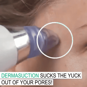 مزيل الرؤوس السوداء