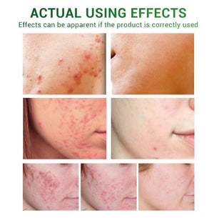 Acne Treatment Serum Facial Repair Oil - Zambeel