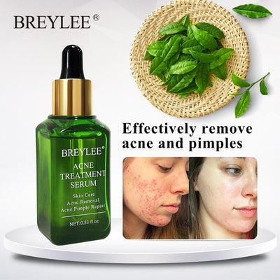 BREYLEE Acne Treatment Serum Face Facial Anti Acne Scar Removal Cream Skin Care Whitening Repair Pimple Remover For Acne - Zambeel