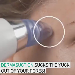 مزيل الرؤوس السوداء